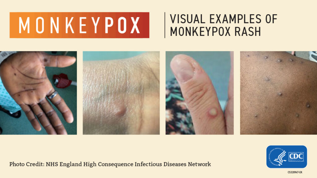 images of monkeypox (mpx)