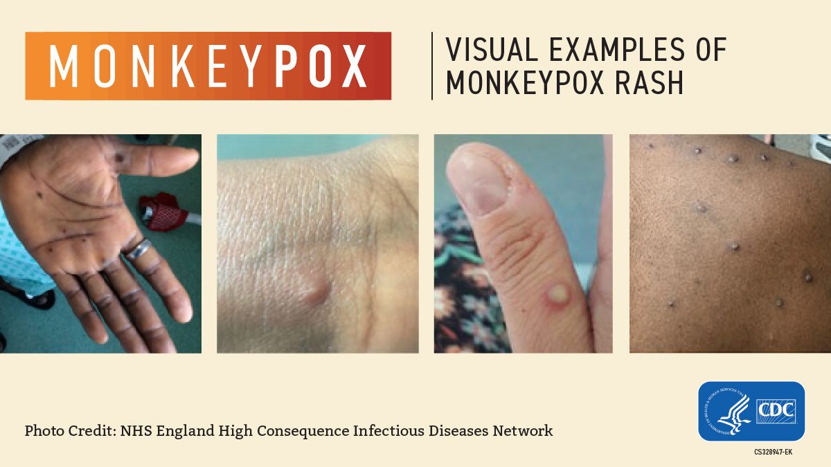 Monkeypox, Emergency & Crisis Notification