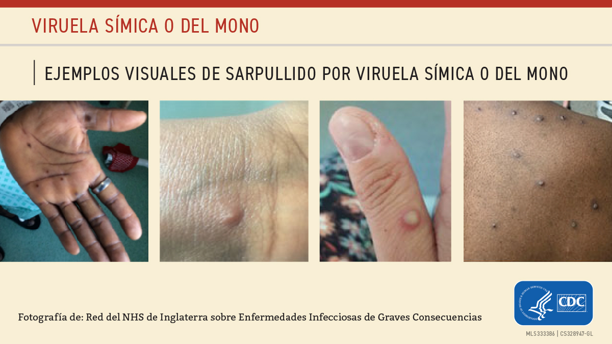 Mpox (anteriormente conocida como viruela del mono) Boulder County