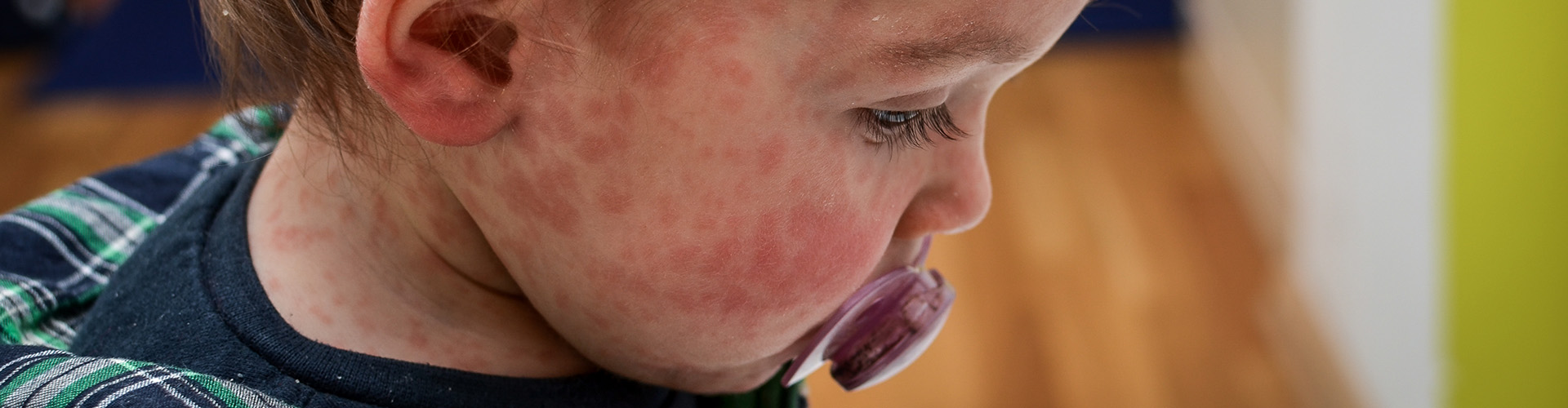 baby with measles rash on his face